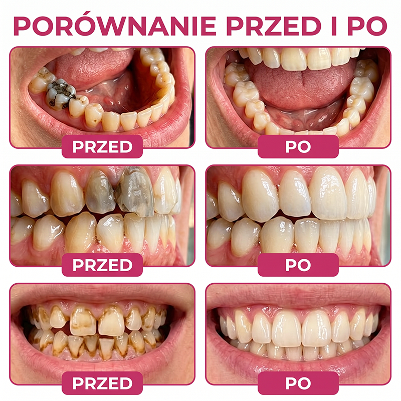 Rolimey® DenPerm – Naturalny żel wypełniający szkliwo do leczenia ubytków próchnicowych🐸